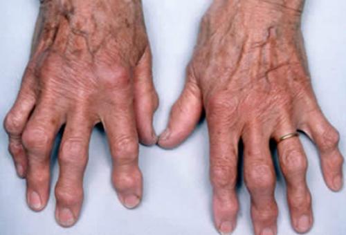 На пальцах рук растут косточки. Причины нарушения 01