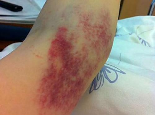 После ушиба болит локоть долго. Обзор ушиба локтевого сустава: виды, степени, симптомы и лечение