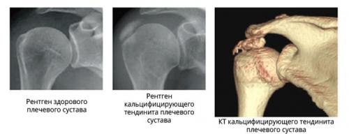 Хрустит плечо при вращении и болит. Тендинит