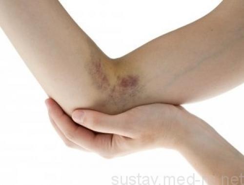 После ушиба болит локоть, что делать. Что делать при ушибах локтя при падении — симптомы и лечение