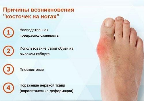 Почему растет косточка на ноге?