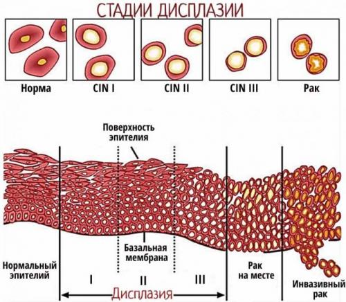 Дисплазия это. Что такое дисплазия шейки матки?