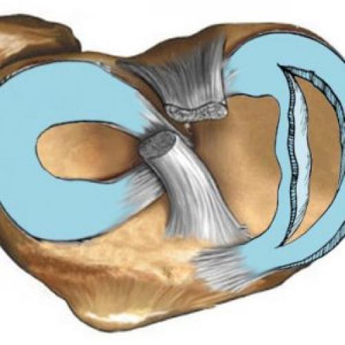 Если разрыв мениска, что делать. Общие данные