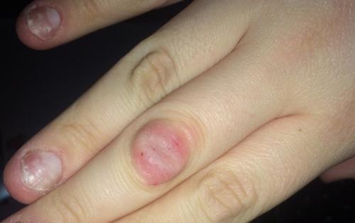 Растет косточка на указательном пальце левой руки. Шишка на руках