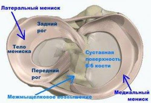 Картина разрыва заднего рога медиального мениска