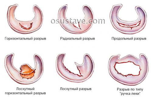 Дегенеративные изменения заднего рога медиального мениска. Дегенеративные изменения менисков: заднего рога, медиального, 4 степени патологии