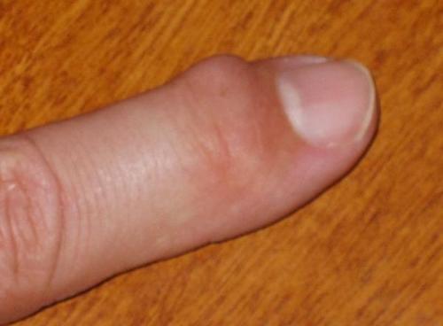 Растет косточка на указательном пальце левой руки. Шишка на руках