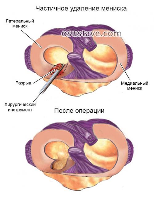 Нужно ли удалять мениск если он поврежден. Техника полного и частичного удаления мениска, эффективность операции, осложнения