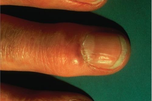 Растет косточка на указательном пальце левой руки. Шишка на руках