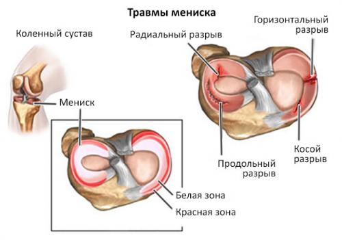 Нужно ли удалять мениск если он поврежден. Техника полного и частичного удаления мениска, эффективность операции, осложнения