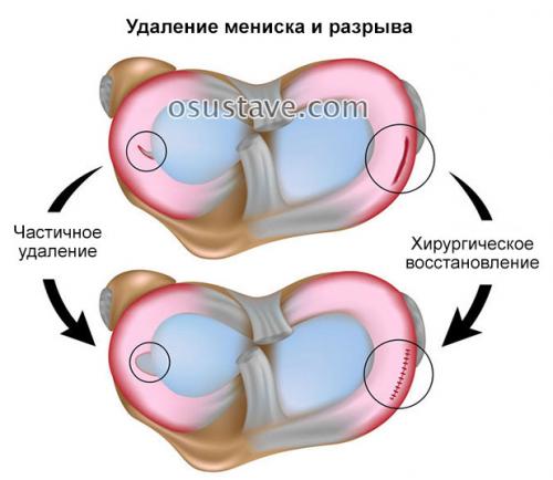Нужно ли удалять мениск если он поврежден. Техника полного и частичного удаления мениска, эффективность операции, осложнения
