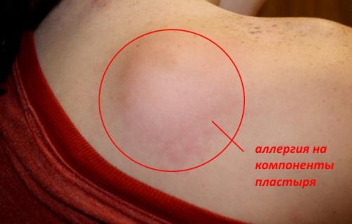 Пластырь от боли в шее, какой лучше. Помогает ли пластырь от остеохондроза?