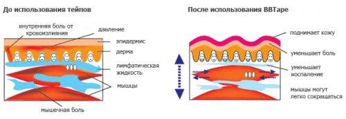 Как наложить кинезио тейп на плечо. Что такое кинезиотейпирование?