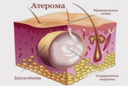 Атерома шеи код по мкб 10 у взрослых. Основные признаки и причины