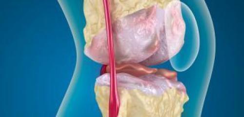 Инъекции гиалуроновой кислоты побочные эффекты. Гиалуроновая кислота: вред и побочные эффекты 03 Инъекции гиалуроновой кислоты побочные эффекты. Гиалуроновая кислота: вред и побочные эффекты 03