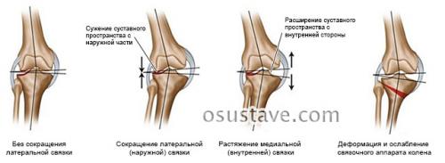 Вальгусная деформация коленных суставов у детей гипсование. Вальгус коленных суставов у детей и взрослых: причины, диагностика, лечение