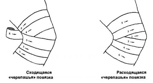 Сходящаяся и расходящаяся повязка на коленный сустав. Виды и показания к применению
