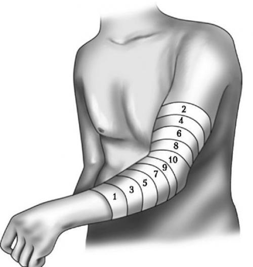 Сходящаяся черепашья повязка на коленный сустав. Черепашья повязка на коленный сустав
