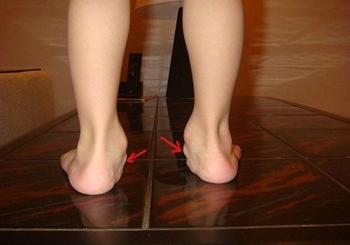 Вальгусная деформация стопы у детей гипсование. Факторы, влияющие на развитие вальгусной деформации у ребенка