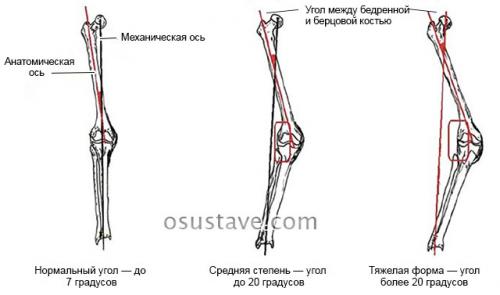 Вальгусная деформация коленных суставов у детей гипсование. Вальгус коленных суставов у детей и взрослых: причины, диагностика, лечение