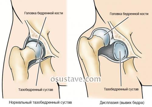 Вальгусная деформация коленных суставов у детей гипсование. Вальгус коленных суставов у детей и взрослых: причины, диагностика, лечение