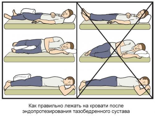 Реабилитация после замены тазобедренного сустава. Описание реабилитации после операции по эндопротезированию тазобедренного сустава