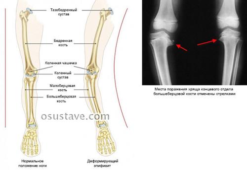 Вальгусная деформация коленных суставов у детей гипсование. Вальгус коленных суставов у детей и взрослых: причины, диагностика, лечение