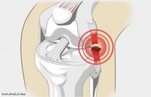 Лечение коленного сустава. Эффективные средства от боли в коленном суставе