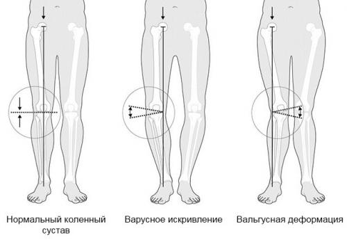 Вальгусная деформация коленных суставов у детей гипсование. Вальгус коленных суставов у детей и взрослых: причины, диагностика, лечение