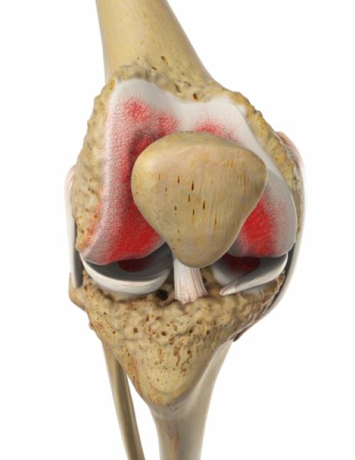 Частичный разрыв мениска коленного сустава, что делать. Частичный разрыв мениска коленного сустава 01