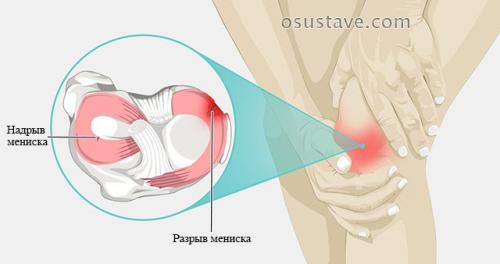 Разрыв заднего рога внутреннего мениска 3 степени лечение без операции. Виды повреждений мениска коленного сустава: их обзор, степени, симптомы и лечение