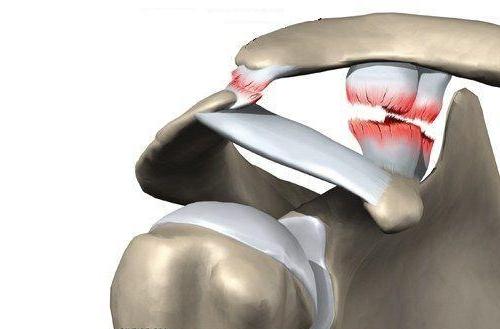 Частичный разрыв акромиально-ключичного сочленения. Лечение разрывов акромиально-ключичного сочленения