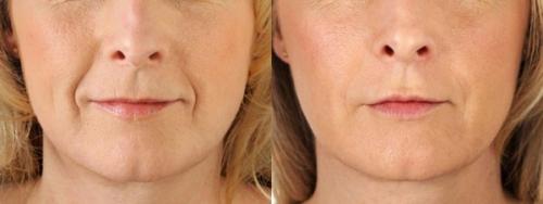 Укол гиалуроновой кислоты. О филлерах