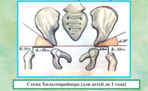 Дисплазия тазобедренного сустава рентген. Что такое дисплазия тазобедренного сустава и ее проявления