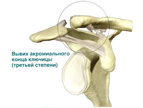 Частичный разрыв акромиально-ключичного сочленения. Лечение разрывов акромиально-ключичного сочленения
