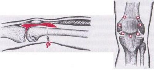 Уколы при синовите колена. Особенности заболевания