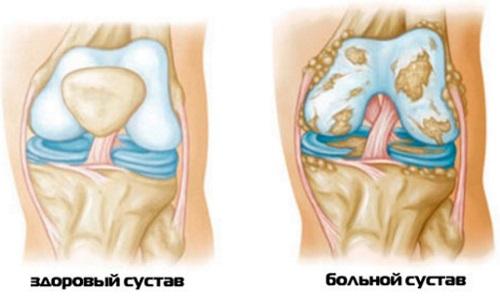 Артрит коленного сустава мкб 10 код. Классификация, уровень заболеваемости