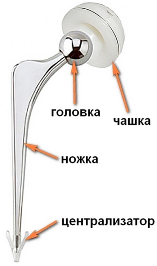 Эндопротез тазобедренного сустава сколько стоит. Купить протез тазобедренного сустава в Москве 05 Эндопротез тазобедренного сустава сколько стоит. Купить протез тазобедренного сустава в Москве 05