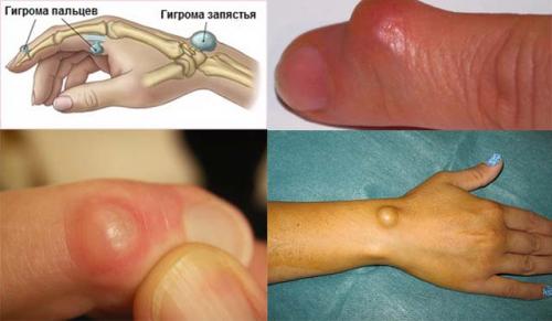 Шишки на фалангах указательного. Виды и симптомы