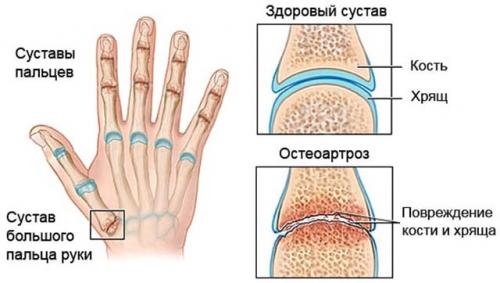 Шишки на фалангах указательного. Виды и симптомы