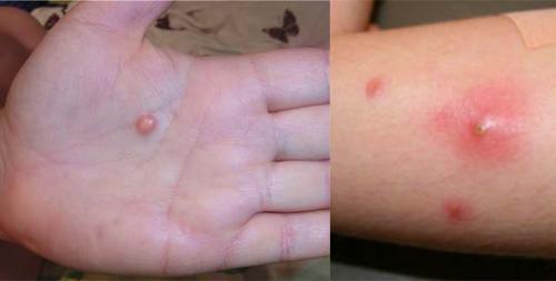 Шишки на фалангах указательного. Виды и симптомы