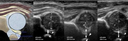 УЗИ тазобедренного сустава методика. УЗИ тазобедренных суставов у младенцев