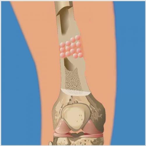 Жидкий протез для тазобедренного сустава. Эндопротезирование суставов. Новые технологии 01