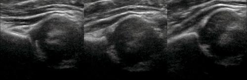 УЗИ тазобедренного сустава методика. УЗИ тазобедренных суставов у младенцев