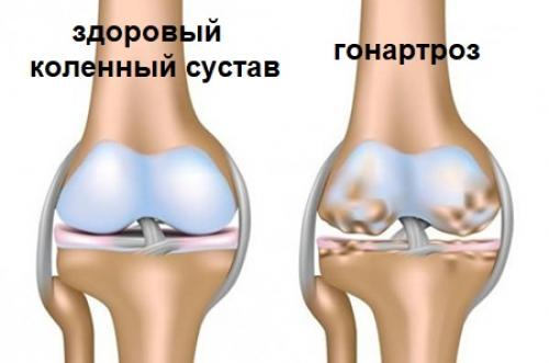 Уколы в колени гиалуроновой кислоты. Гиалуроновая кислота для суставов
