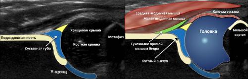 УЗИ тазобедренного сустава методика. УЗИ тазобедренных суставов у младенцев
