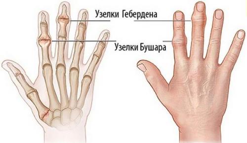 Шишки на фалангах указательного. Виды и симптомы