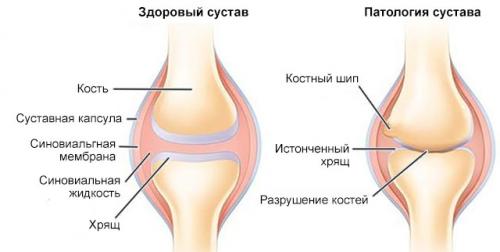 Уколы в колени гиалуроновой кислоты названия в колени. Какого эффекта можно ожидать от гиалуроновой кислоты