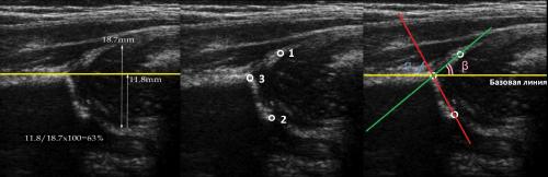 УЗИ тазобедренного сустава методика. УЗИ тазобедренных суставов у младенцев