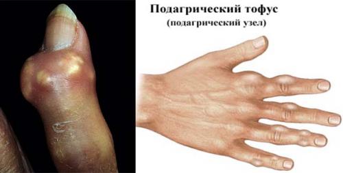 Шишки на фалангах указательного. Виды и симптомы